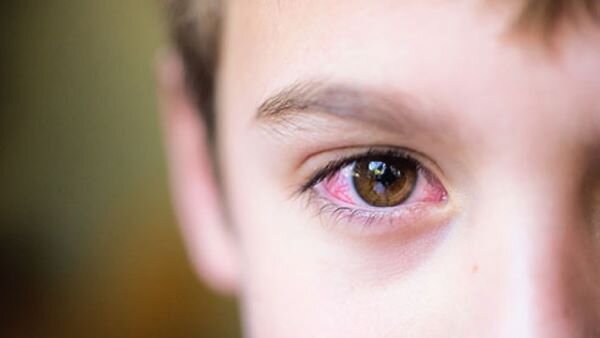 Viêm kết mạc lây qua đường nào? Cách phòng ngừa viêm kết mạc lây lan 0