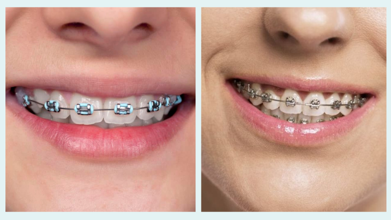 So sánh niềng răng mắc cài kim loại thường và tự buộc 1