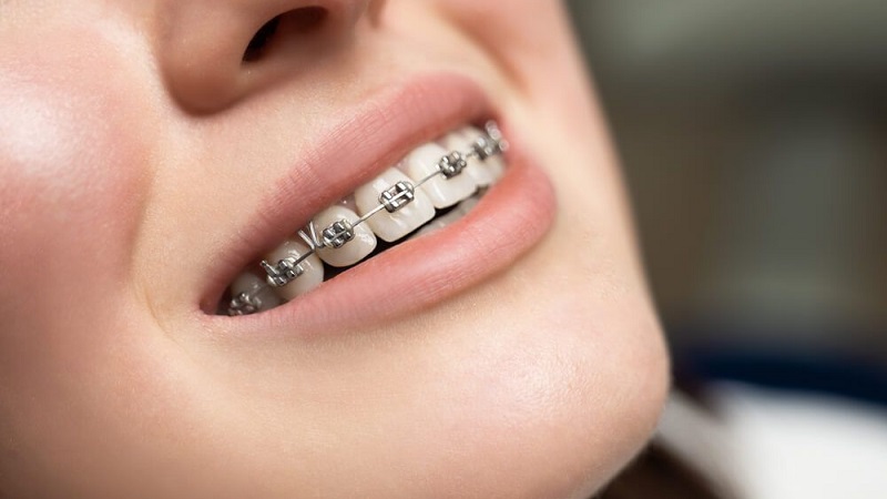 So sánh niềng răng mắc cài kim loại thường và tự buộc 2