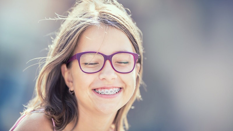 So sánh niềng răng mắc cài kim loại thường và tự buộc 3