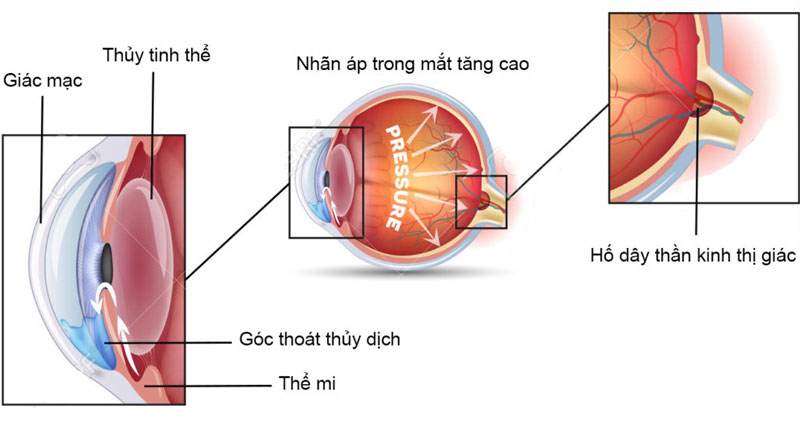 Soi góc tiền phòng là gì? Những thông tin cần biết 2