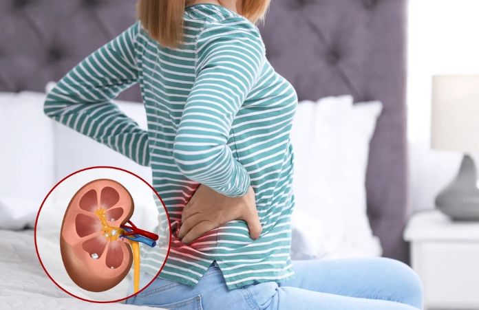 Sỏi thận hình thành như thế nào? Các loại sỏi thận thường gặp nhất 1