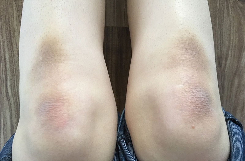 Sử dụng kem mờ thâm Fixderma Nigrilite Cream: Giúp mờ thâm, sáng da! 1