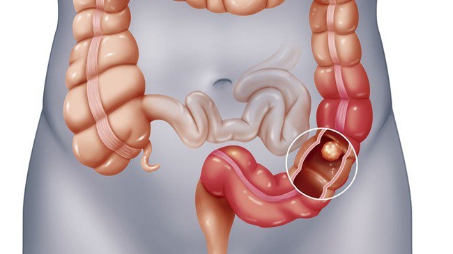 Sự khác nhau giữa bệnh trĩ và ung thư đại trực tràng 1