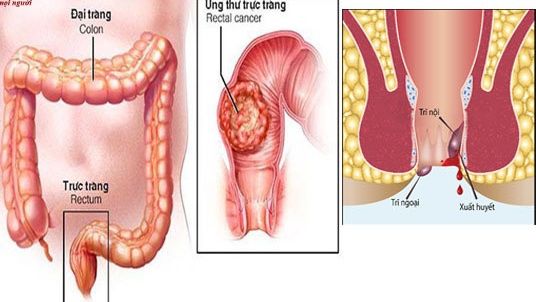 Sự khác nhau giữa bệnh trĩ và ung thư đại trực tràng 3
