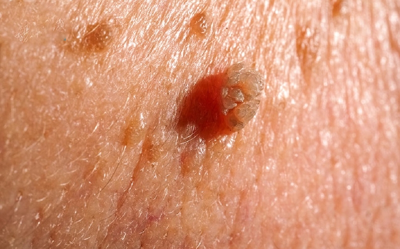 Sùi mào gà âm đạo là bệnh lây truyền qua đường tình dục phổ biến ở nữ giới