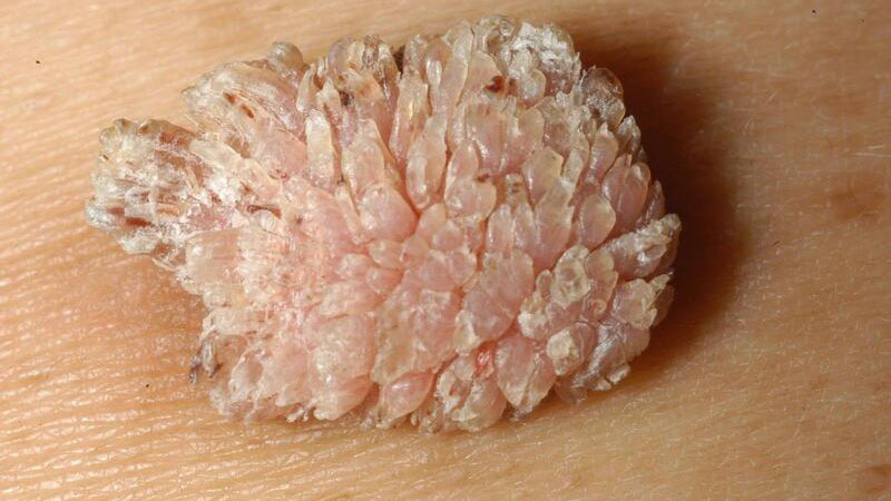 sui-mao-ga-la-benh-gi-nhung-dau-hieu-benh-sui-mao-ga-ban-can-biet 4.jpg 1