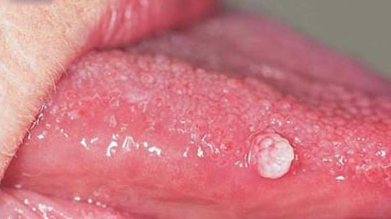 Sùi mào gà ở lưỡi giai đoạn đầu​ có nguy hiểm không? Những biến chứng nếu không điều trị kịp thời  3