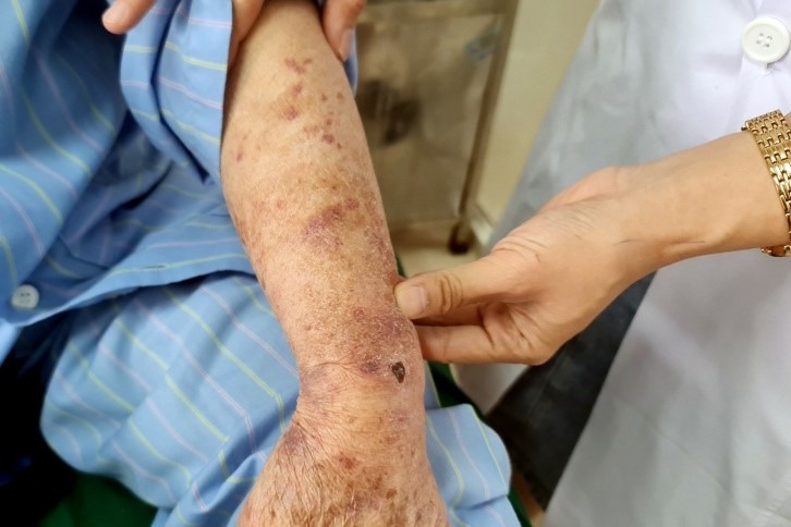 Suy thượng thận do thuốc: Nguyên nhân, triệu chứng và cách phòng ngừa 2