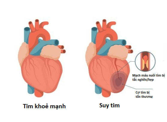 Suy tim là gì? Khám bệnh nhân suy tim gồm những gì? 2