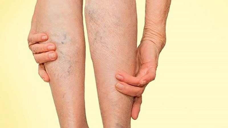 Suy tĩnh mạch mạn là gì? Triệu chứng nhận biết suy tĩnh mạch mạn 1