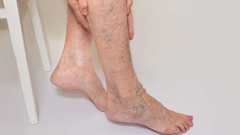 Suy tĩnh mạch mạn là gì? Triệu chứng nhận biết suy tĩnh mạch mạn