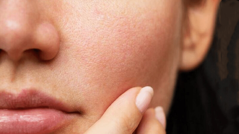 Tác dụng phụ của niacinamide và cách sử dụng niacinamide hiệu quả trong mỹ phẩm 2