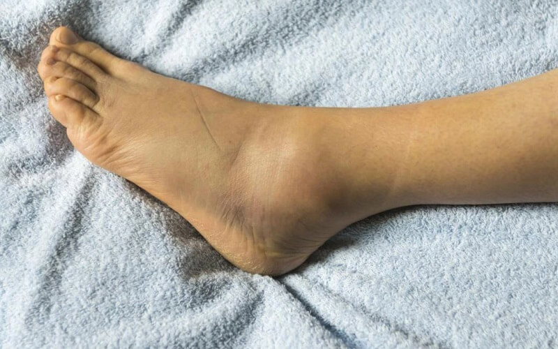 Tác dụng phụ của thuốc hạ huyết áp Amlodipin và những điều cần lưu ý 2