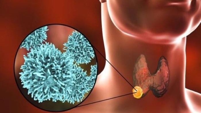 Tác dụng phụ và lưu ý khi thực hiện xạ trị I-131 1