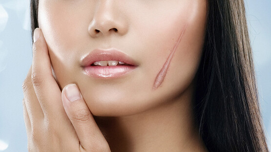 Tác hại của căng chỉ collagen là gì? 5