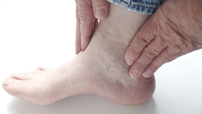 Tại sao đái tháo đường gây suy thận? Biến chứng trên thận có nguy hiểm không? 4