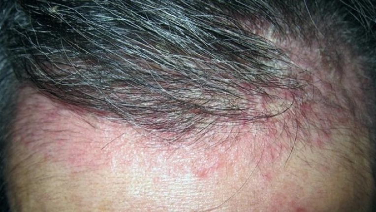 tai-sao-goi-dau-xong-van-ngua-cach-khac-phuc-hieu-qua 4