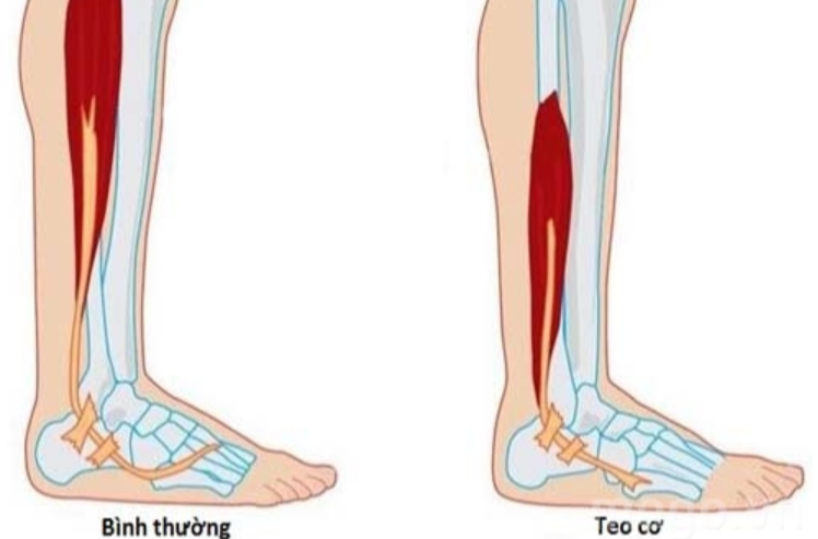 Tại sao lại bị teo cơ chân sau bó bột? 3