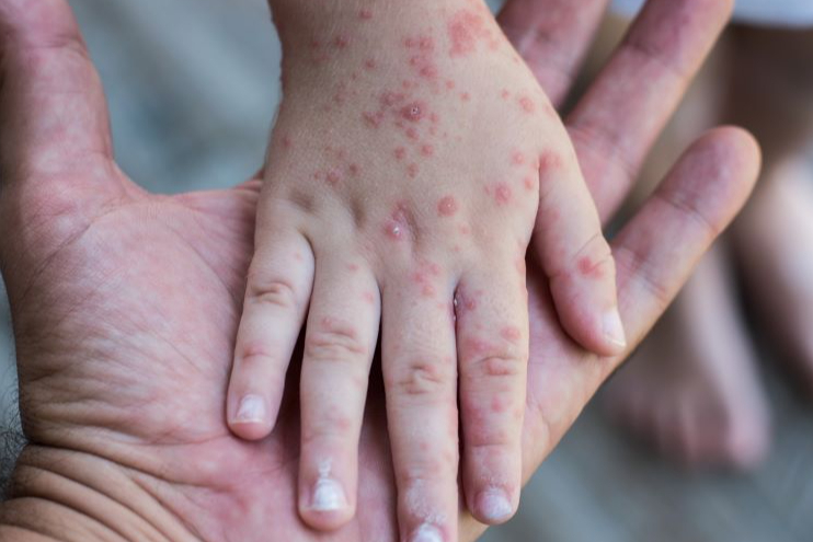 Tại sao trẻ bị điếc bẩm sinh? Trẻ bị điếc thường bị câm? 3