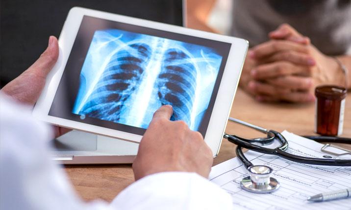 Tầm quan trọng của sàng lọc ung thư phổi 2