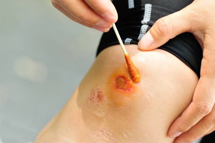 Tầm quan trọng của việc sát khuẩn ngoài da trước các yếu tố bên ngoài 2