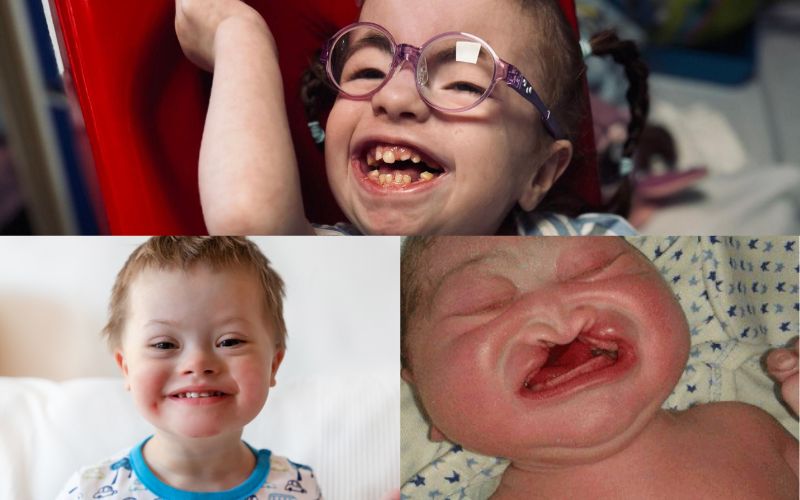 Xét nghiệm NIPT 4 giúp sàng lọc các bất thường nhiễm sắc thể như hội chứng Down, Patau…