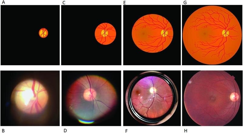 Tầm soát và kiểm soát sớm bệnh võng mạc đái tháo đường: Lời khuyên từ chuyên gia2