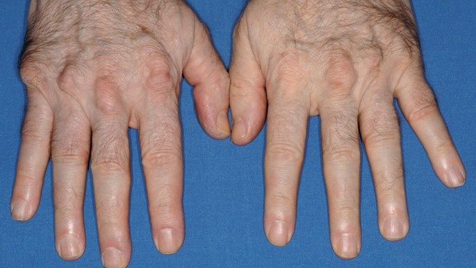 tang-cholesterol-mau-don-thuan-la-benh-gi-va-co-nguy-hiem-khong 3