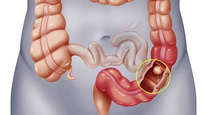 Táo bón thực thể: Nguyên nhân, triệu chứng và cách điều trị 1