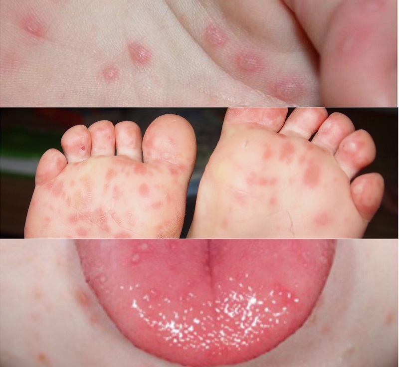 Tất tần tật những điều cần biết về bệnh tay chân miệng ở trẻ sơ sinh 2