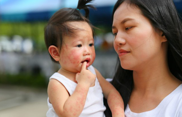 Tay chân miệng độ 1 mấy ngày thì khỏi? Cần lưu ý những gì? 5