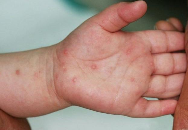 Tay chân miệng là bệnh gì? Biểu hiện của bệnh tay chân miệng 2