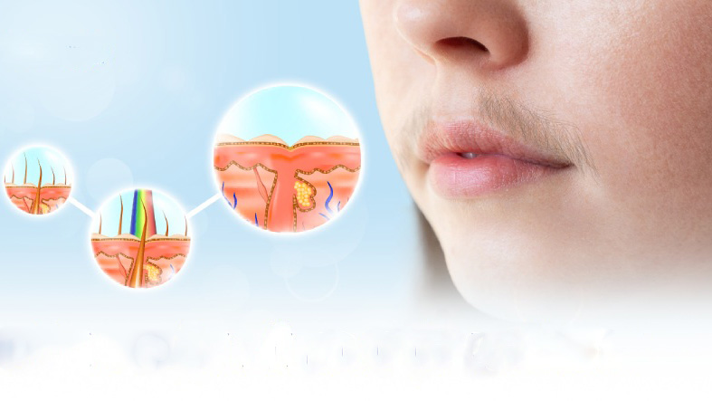 Tẩy lông là gì? Những tác dụng phụ của tẩy lông bạn cần biết 2