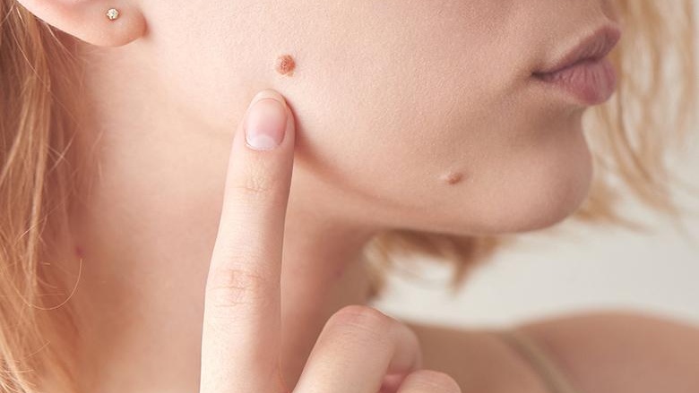 Tẩy nốt ruồi có được uống cà phê không? 3