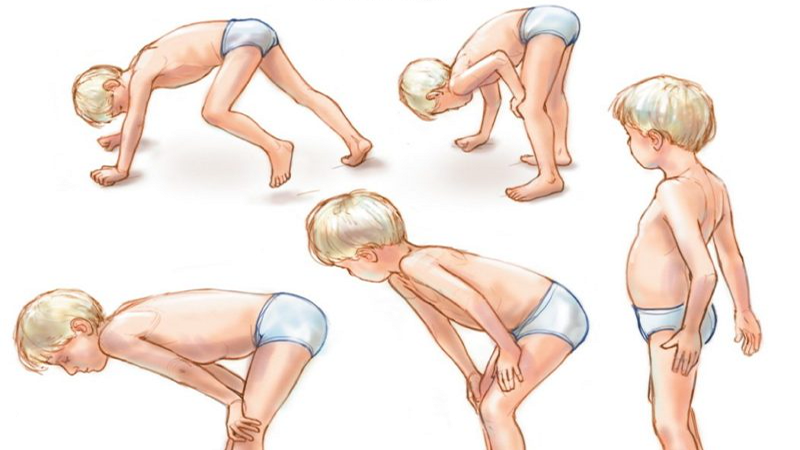 Teo cơ Duchenne: Dấu hiệu, nguyên nhân, chẩn đoán và điều trị 2