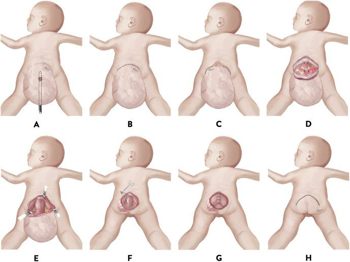 Teratoma là gì? Những triệu chứng của Teratoma 2