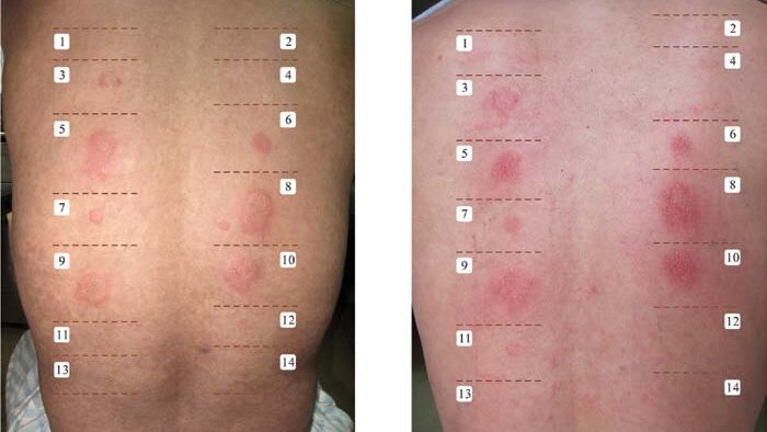 test-ap-bi-la-gi-dung-trong-truong-hop-nao 3.jpg