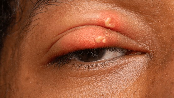 Thắc mắc: Bệnh zona thần kinh ở mắt bao lâu thì khỏi? 2