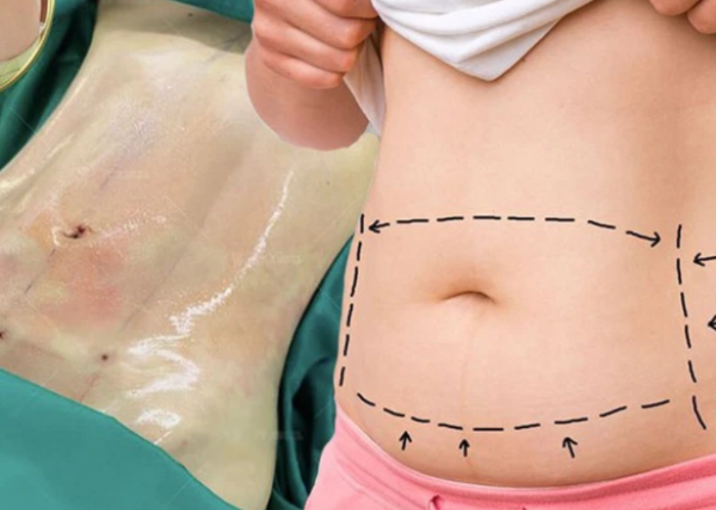 Thắc mắc: Có nên cắt mỡ bụng không? Các nguyên tắc đảm bảo an toàn khi cắt mỡ bụng 1