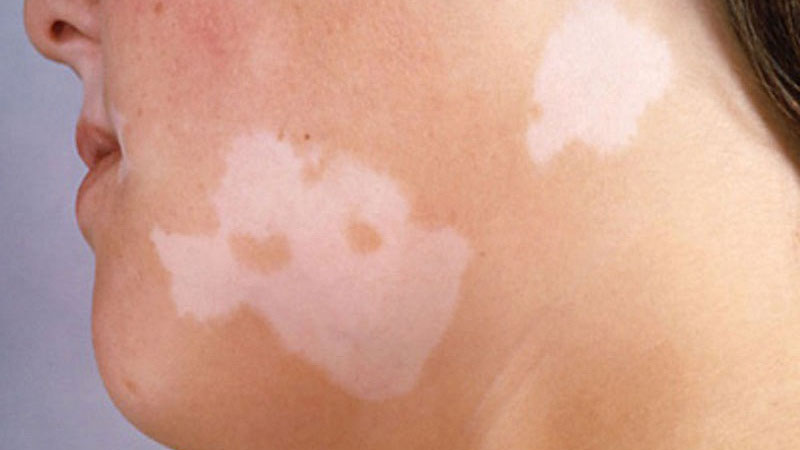 Thắc mắc: Lang ben trắng là bị gì? Cách điều trị lang ben trắng 1