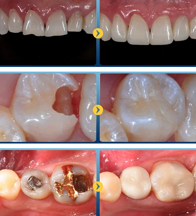 Thắc mắc: Trám răng có đau không? 2