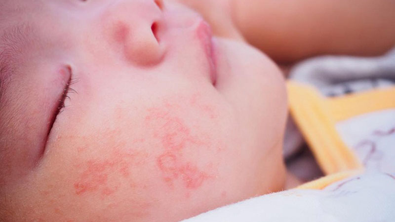 Thắc mắc: Trẻ sơ sinh bị viêm da cơ địa mẹ kiêng ăn gì? 1