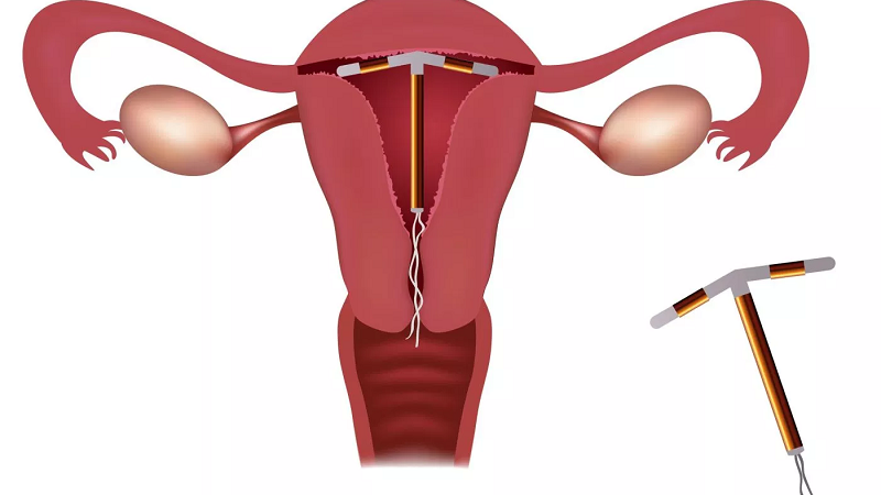 Thắc mắc: Vì sao phải siêu âm kiểm tra vòng tránh thai định kỳ? 1