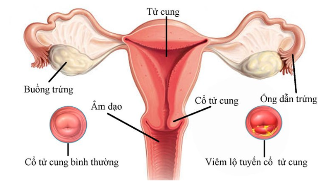 Thắc mắc: Viêm lộ tuyến cổ tử cung 0.5 cm nên làm gì? 4