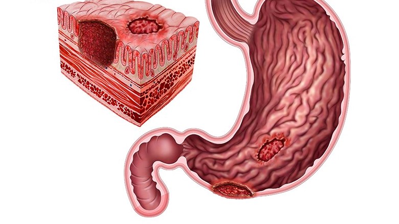 Thắc mắc: Viêm loét dạ dày có chữa khỏi được không? 4