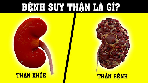 Suy thận là tình trạng suy giảm chức năng của cơ quan thận