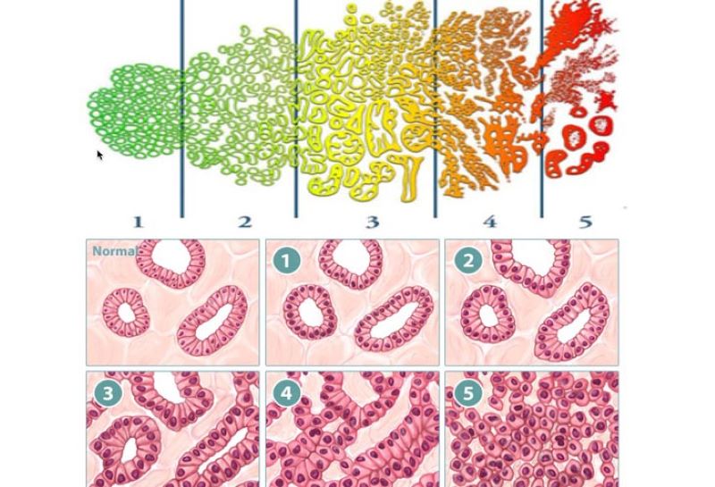 Thang điểm Gleason là gì? Những thông tin cần biết về ung thư tuyến tiền liệt 2