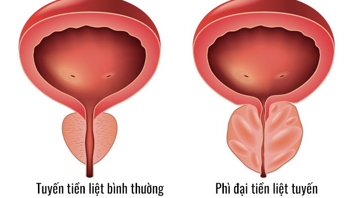 thang-diem-ipss-chia-khoa-chan-doan-va-theo-doi-phi-dai-tuyen-tien-liet 1