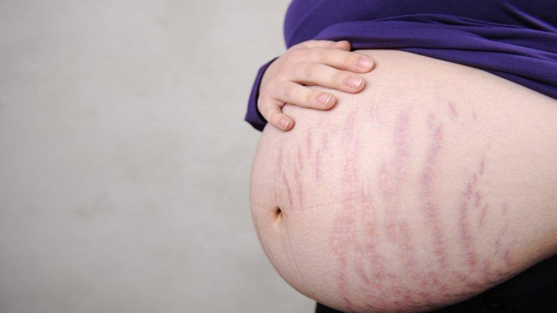 Thành bụng mỏng khi mang thai có sao không?  3